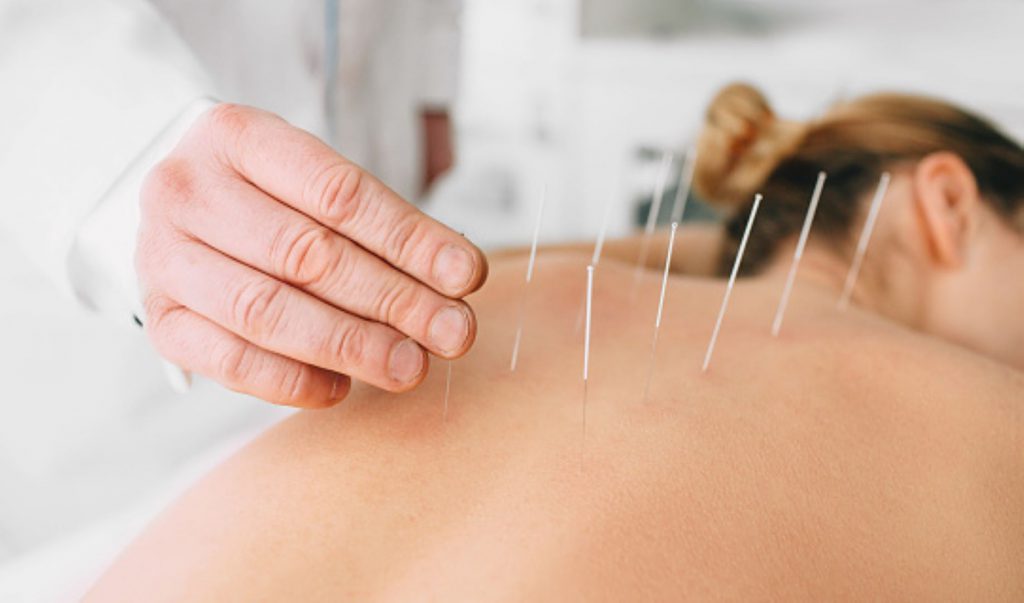 femme recevant traitement d'acupuncture