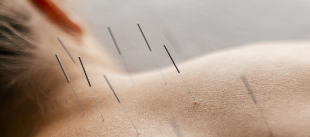 aiguilles acupuncteur traitement acupuncture